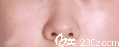 鼻形困擾之一蒜頭鼻