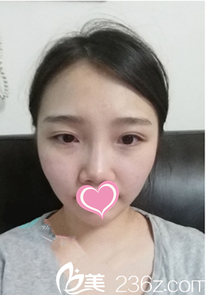 韓國COWELL整形外科手術前 韓國COWELL整形外科手術前