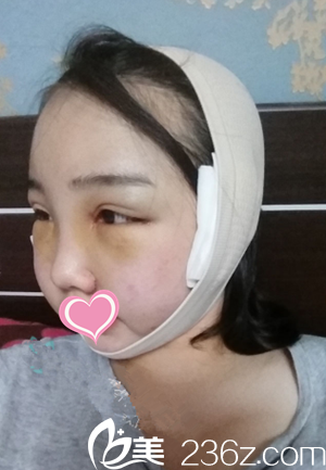 手術后第3天 手術后第3天