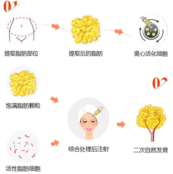 溫州芘麗芙自體脂肪移植過程 溫州芘麗芙自體脂肪移植過程