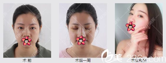 劉翠竹玻尿酸隆鼻和填充全臉案例