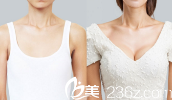 胸部整形前后對比