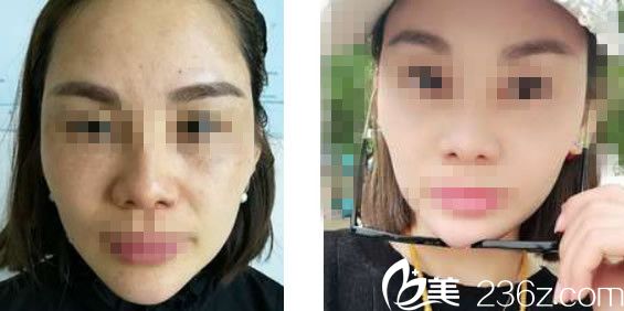 蘭州明倫關(guān)欣激光祛黃褐斑效果 蘭州明倫關(guān)欣激光祛黃褐斑效果