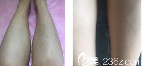 蘭州明倫激光脫毛案例 蘭州明倫激光脫毛案例