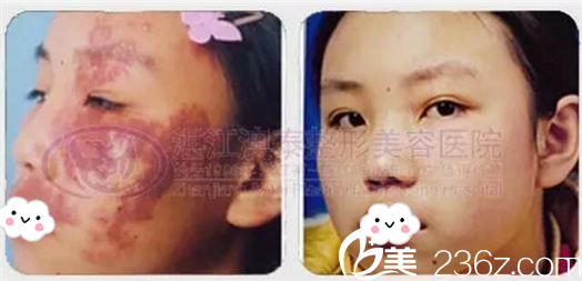 湛江澳泰整形醫(yī)院曾兆舜胎記祛除案例 湛江澳泰整形醫(yī)院曾兆舜胎記祛除案例