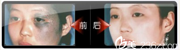 湛江澳泰整形醫(yī)院曾兆舜太田痣案例 湛江澳泰整形醫(yī)院曾兆舜太田痣案例