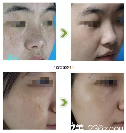 湛江澳泰整形醫(yī)院曾兆舜雀斑治療案例 湛江澳泰整形醫(yī)院曾兆舜雀斑治療案例