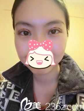 鄭州一美雙眼皮手術(shù)后3天