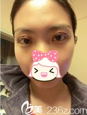 一美雙眼皮手術(shù)后第三天