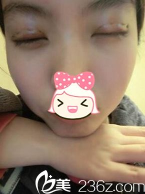 一美雙眼皮手術(shù)后三天閉眼照