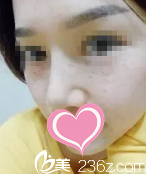 術前正面照 術前正面照