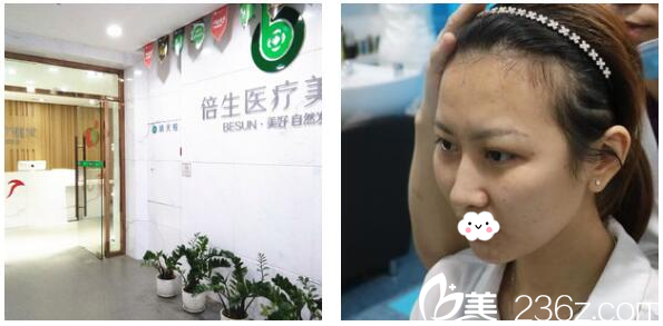 來到廣州倍生植發(fā)醫(yī)院