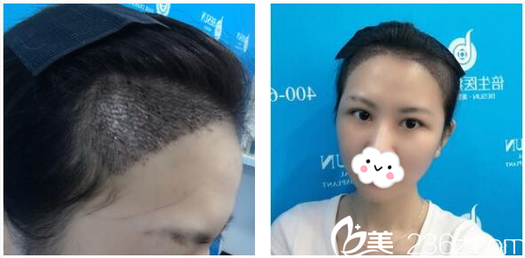 找廣州倍生植發(fā)醫(yī)院廖駿植發(fā)第4天