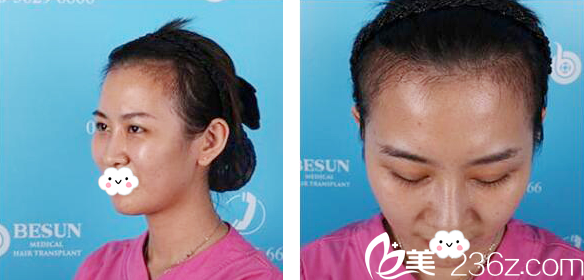 廣州倍生植發(fā)醫(yī)院發(fā)際線種植2個月