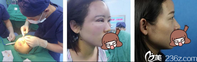 長沙美萊潘衛(wèi)峰自體脂肪面部填充案例