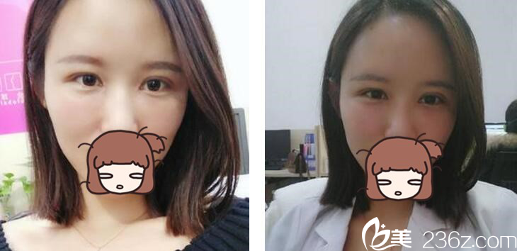 自體脂肪豐額頭+雙眼皮真人案例