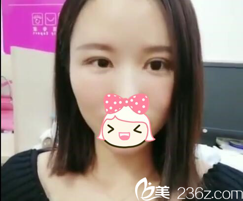 術(shù)后第28天