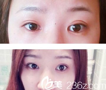蘭州明倫雙眼皮失敗修復(fù)效果案例 蘭州明倫雙眼皮失敗修復(fù)效果案例