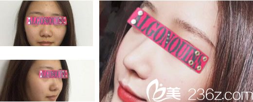 蘭州明倫隆鼻案例 蘭州明倫隆鼻案例