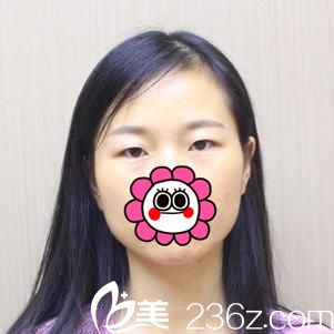 術(shù)前單眼皮 術(shù)前單眼皮