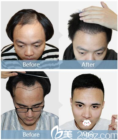 深圳<!--<i data=20240703-sp></i>-->植發(fā)醫(yī)院男士發(fā)際線種植 深圳<!--<i data=20240703-sp></i>-->植發(fā)醫(yī)院男士發(fā)際線種植