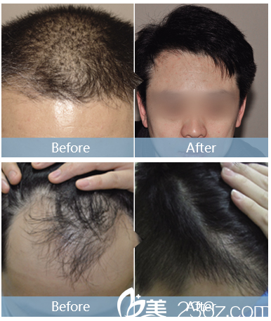 深圳<!--<i data=20240703-sp></i>-->植發(fā)醫(yī)院頭發(fā)加密 深圳<!--<i data=20240703-sp></i>-->植發(fā)醫(yī)院頭發(fā)加密