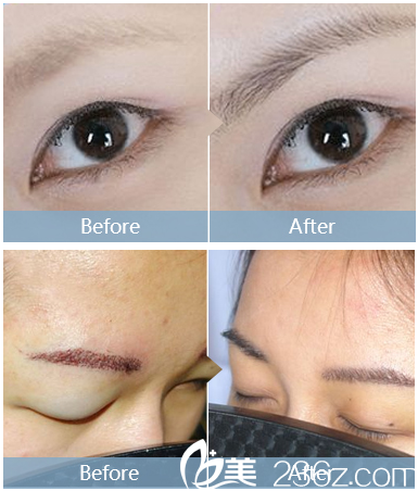 深圳<!--<i data=20240703-sp></i>-->植發(fā)醫(yī)院眉毛種植 深圳<!--<i data=20240703-sp></i>-->植發(fā)醫(yī)院眉毛種植