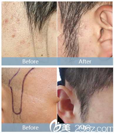 深圳<!--<i data=20240703-sp></i>-->植發(fā)醫(yī)院鬢角種植 深圳<!--<i data=20240703-sp></i>-->植發(fā)醫(yī)院鬢角種植