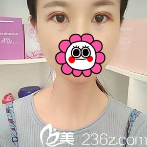 術(shù)后四天效果 術(shù)后四天效果