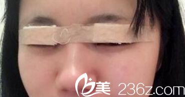 蘭州明倫雙眼皮整形天 蘭州明倫雙眼皮整形天