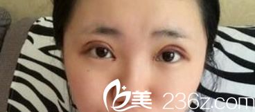 蘭州明倫雙眼皮整形天 明倫割雙眼皮第三天 蘭州明倫雙眼皮整形天 明倫割雙眼皮第三天