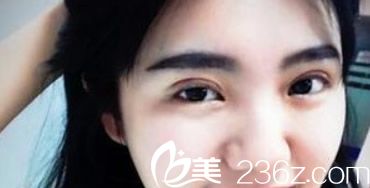 蘭州明倫雙眼皮第十天效果 蘭州明倫雙眼皮第十天效果