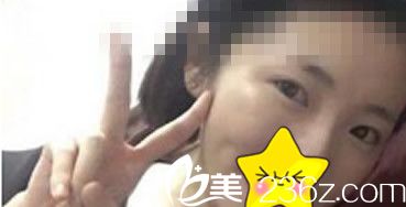 蘭州明倫馮建業(yè)切開(kāi)法雙眼皮前 蘭州明倫馮建業(yè)切開(kāi)法雙眼皮前