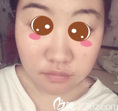 在鄭州梨花雨做隆鼻術(shù)前 在鄭州梨花雨做隆鼻術(shù)前