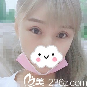 腫泡眼一個月秒變魅力電眼，原來我也可以這么美