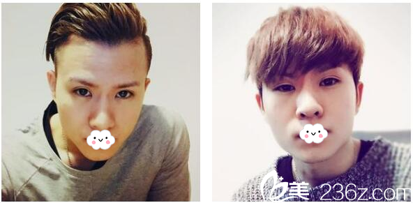 執(zhí)法前發(fā)際線都是天生M型 執(zhí)法前發(fā)際線都是天生M型