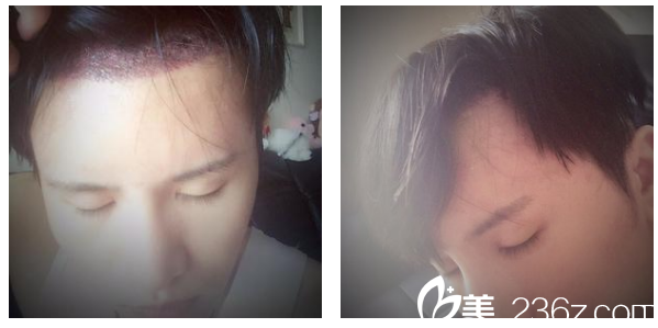 周龍飛醫(yī)生植發(fā)天情況 周龍飛醫(yī)生植發(fā)天情況