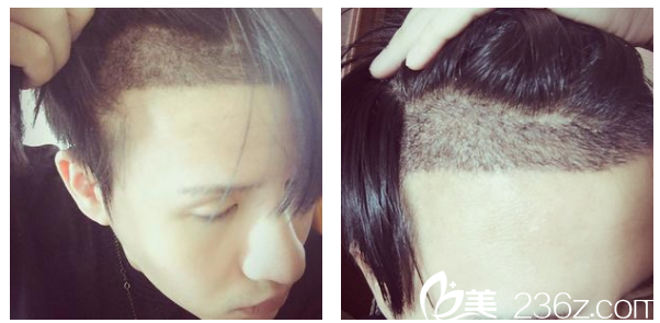 植發(fā)13太難血痂清理干凈后的細(xì)節(jié)圖 植發(fā)13太難血痂清理干凈后的細(xì)節(jié)圖