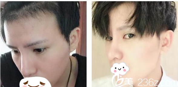 天生M型發(fā)際線的我找深圳植發(fā)周龍飛做了2300單位發(fā)際線種植