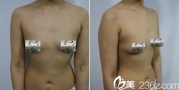 在金華亞美做自體脂肪隆胸前的平胸照片 在金華亞美做自體脂肪隆胸前的平胸照片