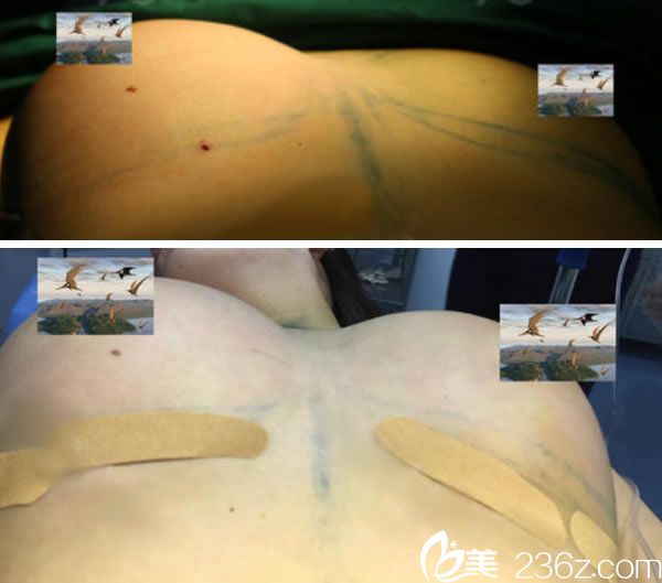 金華亞美薛磊自體脂肪隆胸過程 金華亞美薛磊自體脂肪隆胸過程