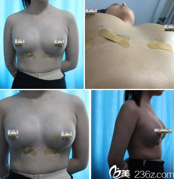 自體脂肪隆胸手術(shù)7天恢復照 自體脂肪隆胸手術(shù)7天恢復照