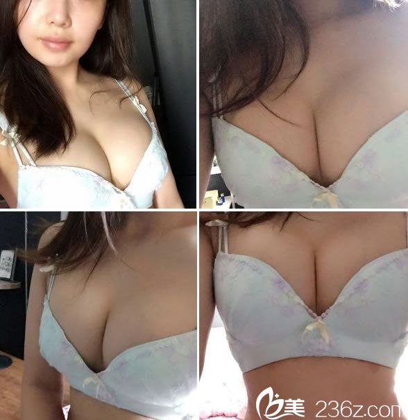 隆胸手術(shù)16天的恢復<span style= 隆胸手術(shù)16天的恢復<span style=