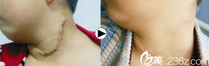 梁安裕疤痕修復(fù)案例1 梁安裕疤痕修復(fù)案例1