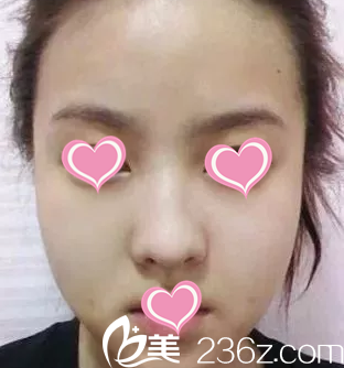 注射瘦臉后第四天 注射瘦臉后第四天