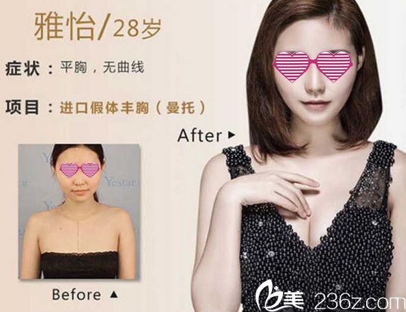 寧波藝星進(jìn)口曼托假體豐胸案例 寧波藝星進(jìn)口曼托假體豐胸案例