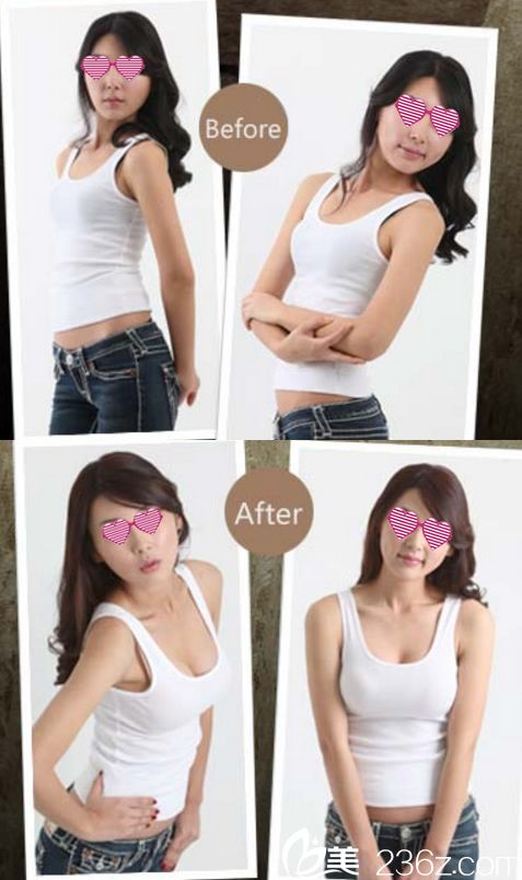 寧波藝星整形醫(yī)院假體隆胸案例 寧波藝星整形醫(yī)院假體隆胸案例