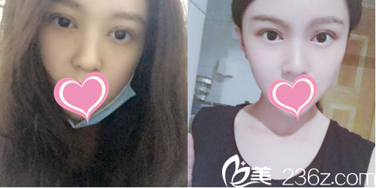 宋方醫(yī)生給我做的雙眼皮樣子