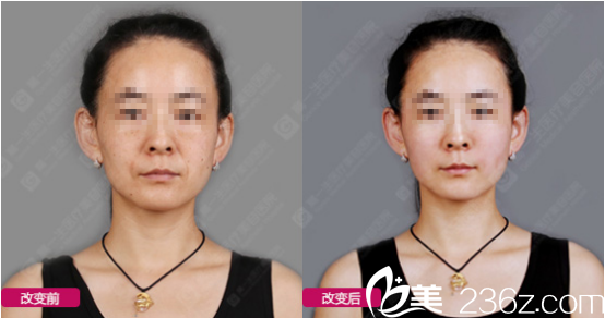 金磊醫(yī)生玻尿酸豐蘋果肌<span style=