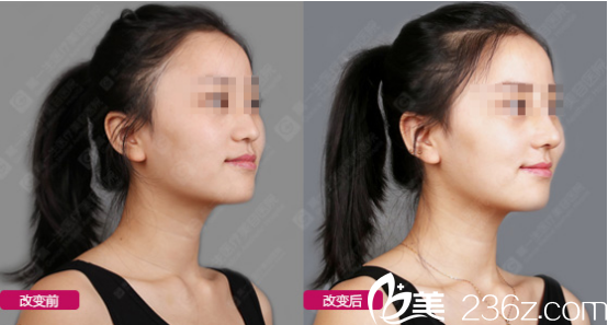 西安高一生玻尿酸豐蘋果肌<span style=